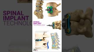 Surgical Device Medical Animation Prism Surgical  AQUILABOREALIS ACDF Spinal System 3d short [upl. by Ddahc]