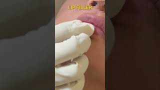 Lip Filler Treatment ✨ [upl. by Johny]