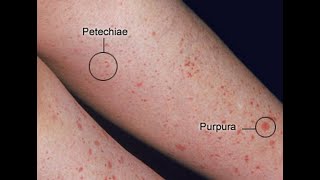 Petechiae  Definition Causes Disease associations Symptoms Diagnosis Treatment [upl. by Eziechiele]