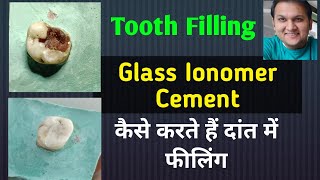 Tooth Filling Glass Ionomer Cement  GIC Restoration  GIC filling [upl. by Burner]