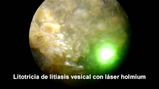 Litotricia litiasis vesical laser holmium Holmium laser lithotripsy in bladder stone [upl. by Oisacin]