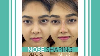 Nose Shaping নাকের শেইপ ঠিক করা  Nose Job  NonSurgical Rhinoplasty  Laser Treat  Dr Shamim [upl. by Tenahs]