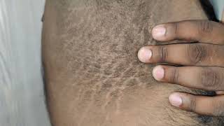 Acanthosis Nigricans [upl. by Berners]