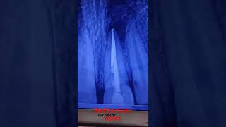 radicular cystviralshort shortvideo dentaltreatment periapical cystdentist [upl. by Staci]