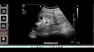 Renal Papillary NecrosisUltrasound Vs CT [upl. by Gurias]