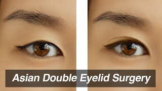 Asian Blepharoplasty Monolid to Double Eyelid Surgery [upl. by Eimmit]