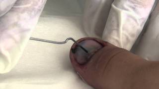 Trephining a nail to drain subungual haematoma [upl. by Barde]