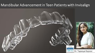 Case 4 Mandibular Advancement with Invisalign in a growing teen patient [upl. by Niobe]