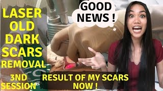 Laser Old Dark Scars Removal  3rd Session  How much does it cost   Feel the pain again  Part 6 [upl. by Andrey]