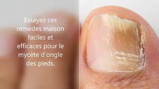 Comment jai soigné ma mycose des pieds facilement et naturellement  Allez Santé [upl. by Leoy]