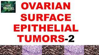 OVARIAN TUMORS  Part 3  ENDOMETRIOID CLEAR CELL amp BRENNER TUMOR Pathology [upl. by Nnaylrebmik677]