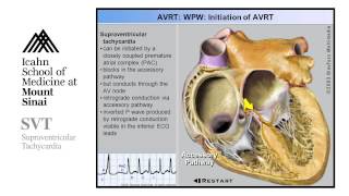 Supra Ventricular Tachycardia [upl. by Ennelram654]