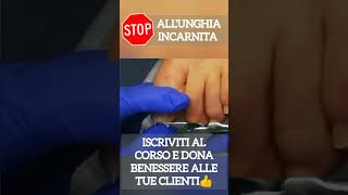 STOP al dolore dellunghia incarnita [upl. by Nsaj]