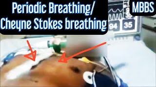 Periodic Breathing Cheyne Stokes Breathing mbbs medicine neetpg usmle next aiims neet [upl. by Argile505]