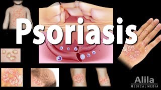 Psoriasis Types Symptoms Causes Pathology and Treatment Animation [upl. by Haeli]