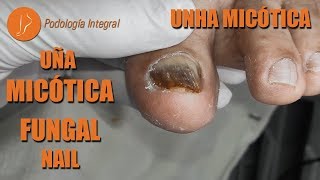 Uña micótica  Fungal nail  Unha micótica Podología Integral [upl. by Theo]