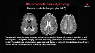 Metachromatic Leukodystrophy  USMLE Biochemistry webinar Case based lecture [upl. by Ladnyc]