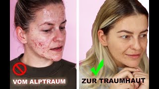 ❗️ In NUR 3 Monaten zur TRAUMHAUT  HEFTIGES Ergebnis ❗️ Microneedling Vorher Nachher Diana Delo [upl. by Nosyrb]