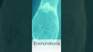 Enchondroma  Pathology shorts [upl. by Frederic]