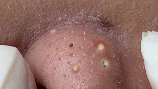 Big Cystic Acne Blackheads Extraction Blackheads amp Milia Whiteheads Removal Pimple Popping  3709 [upl. by Radke]