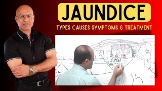 Jaundice  Types Causes Symptoms and Treatment [upl. by Shayla]