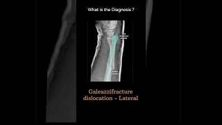 Galeazzi fracturedislocation  Lateral 127 Xray  Upper limb gallery 1 radiologychannel007 [upl. by Dnalrah969]