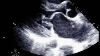 Mitral Stenosis  Echo Clip [upl. by Eciruam]