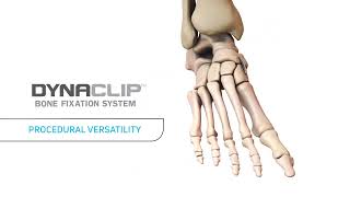 DynaClip® Bone Fixation System Animation [upl. by Venditti669]