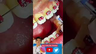 ENAMELOPLASTY Lagaring Ngipin paano inaayos [upl. by Atiana858]