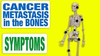 Cancer Metastasis in the Bones  All Symptoms [upl. by Ecnerual448]