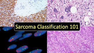 Sarcoma Classification 101 Soft Tissue Tumor Naming Made Simple for Beginners amp NonPathologists [upl. by Ahsieki97]