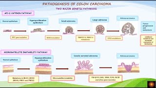 Pathogenesis of colorectal carcinoma  DrVShanthi [upl. by Noreik562]