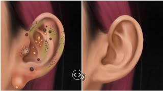 ASMR II EARWAX REMOVAL SATISFYING TREATMENT ANIMATION [upl. by Kirat]