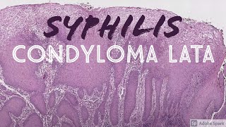 Condyloma Lata Syphilis 5Minute Pathology Pearls [upl. by Vicky]