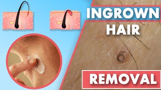 How to get rid of ingrown hairs on legs and thighs at home [upl. by Hornstein]