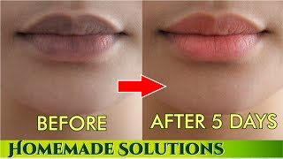 काले होंठो प्राक्रतिक गुलाबी बनाने के नुस्खे  Remove darkness from lips get pink lips [upl. by Ennaimaj703]