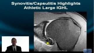 Shoulder MRI Instability Part II How to Deal with Variation Axillary Recess Clefts and Fissures [upl. by Alil573]