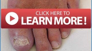 NAIL FUNGUS Symptoms  What You Need To Know About Nail Fungus and Infected Toenail [upl. by Alithia]