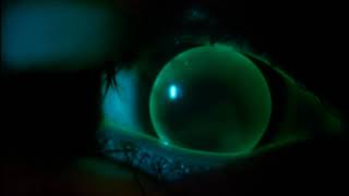 Instructional Video Assessment of a Gas Permeable Contact Lens [upl. by Attiuqehs]