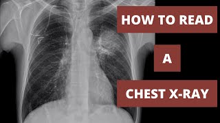 A Radiologists Approach to Reading CXR  Radiology 101 [upl. by Kassity]