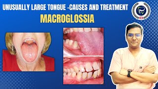 Dr Rudra Mohan  Macroglossia  Enlarged Tongue  Understand Causes and Treatment Options [upl. by Palumbo]