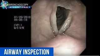 Flexible Bronchoscopy Introduction 6  Airway Inspection Nostril to cords [upl. by Pentha580]