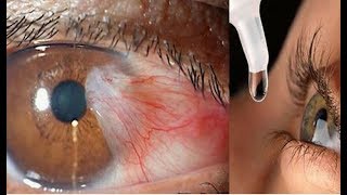 Como Eliminar Las Carnosidades De Tus Ojos De Forma Rápida Y Natural Con Este Remedio Casero [upl. by Odille]