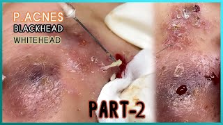 Big Cystic Acne Blackheads Extraction Blackheads amp Milia Whiteheads Removal Pimple Popping [upl. by Showker]