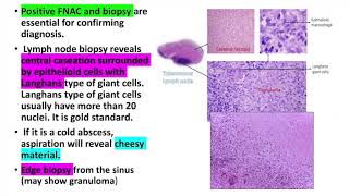 Tuberculous lymphadenitiscervical lymphadenitis Treatment diagnosis and investigations [upl. by Stryker]