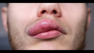 Angioedema  Symptoms and Causes [upl. by Anaya]