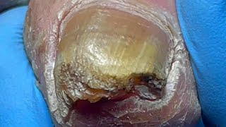 Curly ingrown nails poor onychomycosis【Pedicure Master Lin Jun】 [upl. by Kimon]