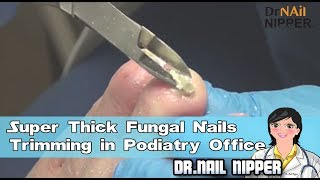 Super Thick Fungal Nails Trimming in Podiatry Office [upl. by Atnoed331]