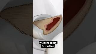 Wisdom Tooth Extraction 3D Animation [upl. by Nnaaras]