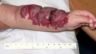 Infantile Hemangiomas aka “Strawberry” Birthmarks [upl. by Perdita]